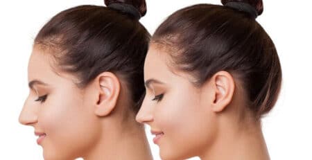 Otoplasty