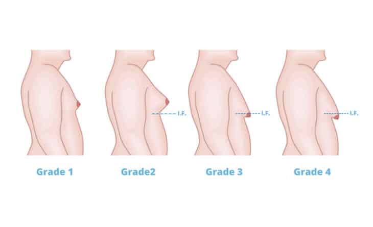 Male breast reduction surgery