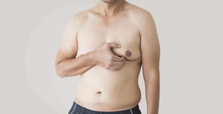 Male breast reduction surgery