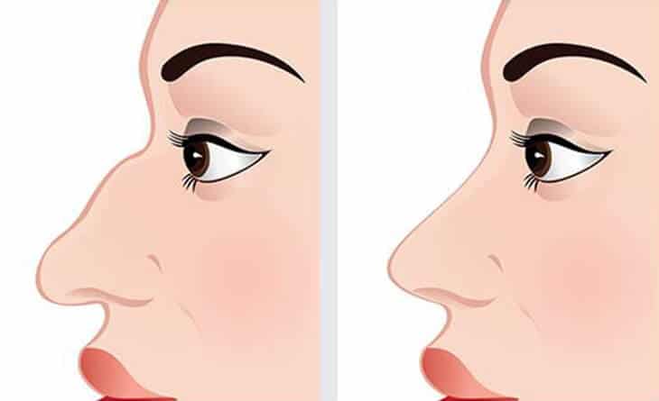 Nose Job - Rhinoplasty Surgery in delhi - Dr Rajat Gupta - Plastic Surgeon in Delhi -033