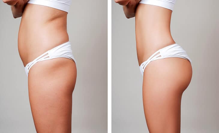 breast and buttock augmentation