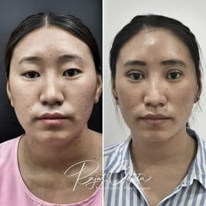 blepharoplasty