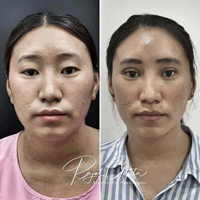 blepharoplasty
