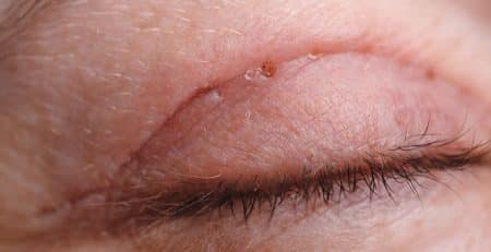 Blepharoplasty in Delhi - Dr Rajat Gupta