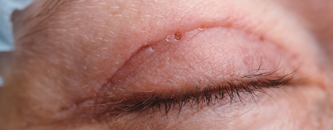 Blepharoplasty in Delhi - Dr Rajat Gupta