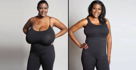 Breast Reduction Surgery in Delhi