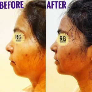 chin augmentation