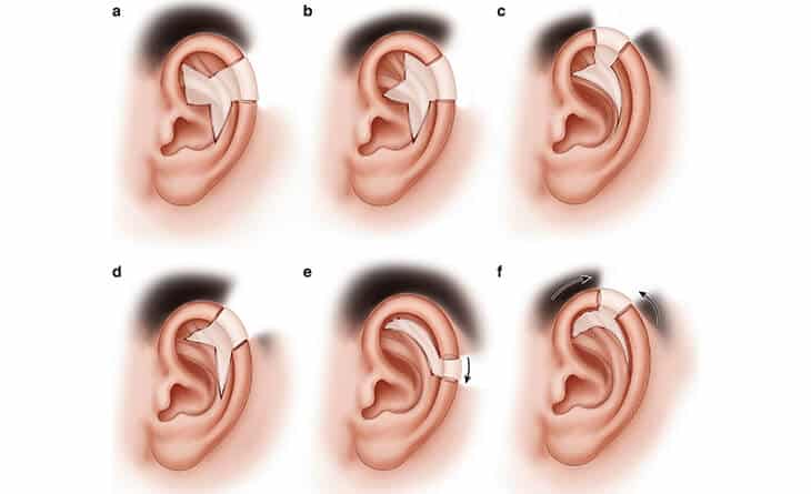 Ear Reconstruction Surgery