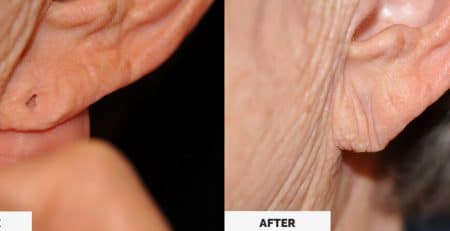 Ear Lobe Repair Surgery
