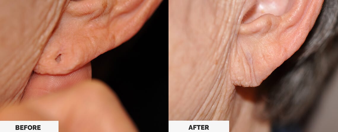 Ear Lobe Repair Surgery
