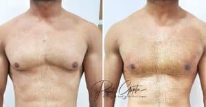 Gynecomastia