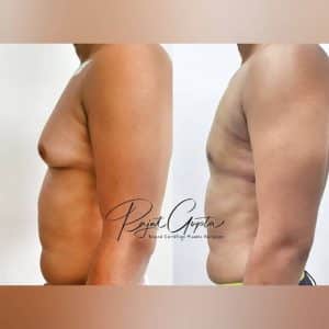 Gynecomastia