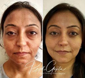 blepharoplasty