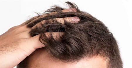 Hair Transplant in Delhi