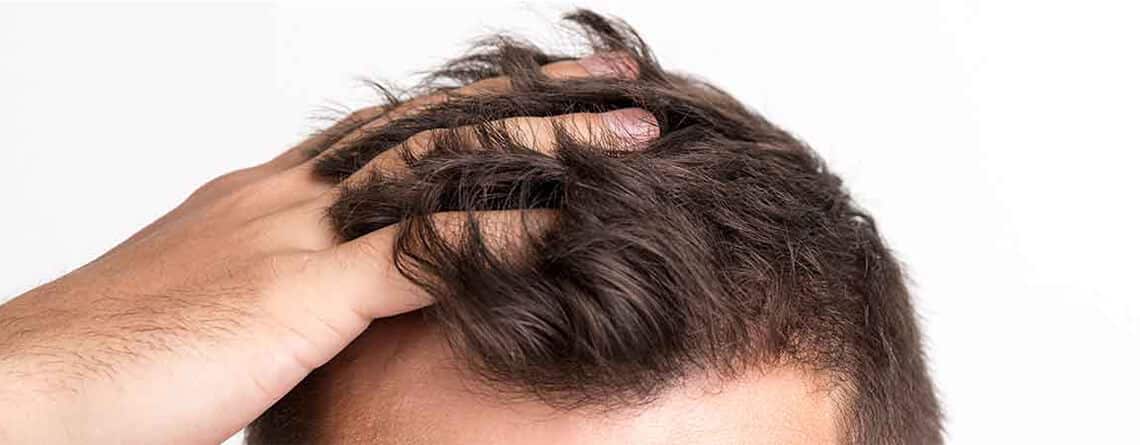 Hair Transplant in Delhi