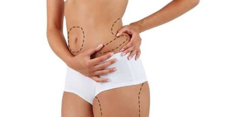 Liposuction Surgery in Delhi