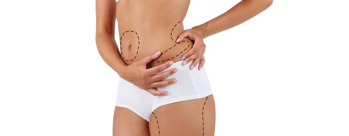 Liposuction Surgery in Delhi