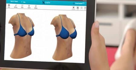 Crisalix 3D Simulation