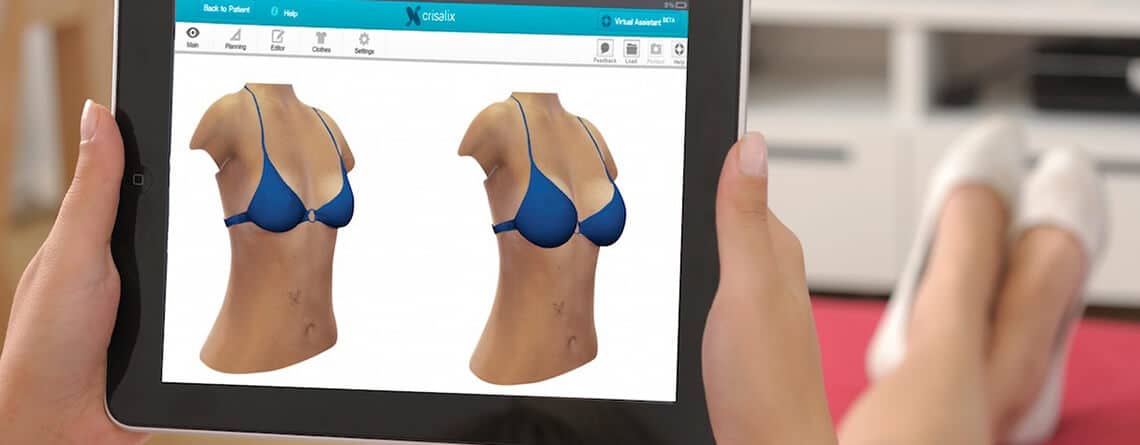 Crisalix 3D Simulation