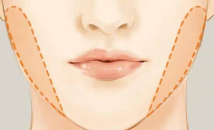 Buccal Pad Removal