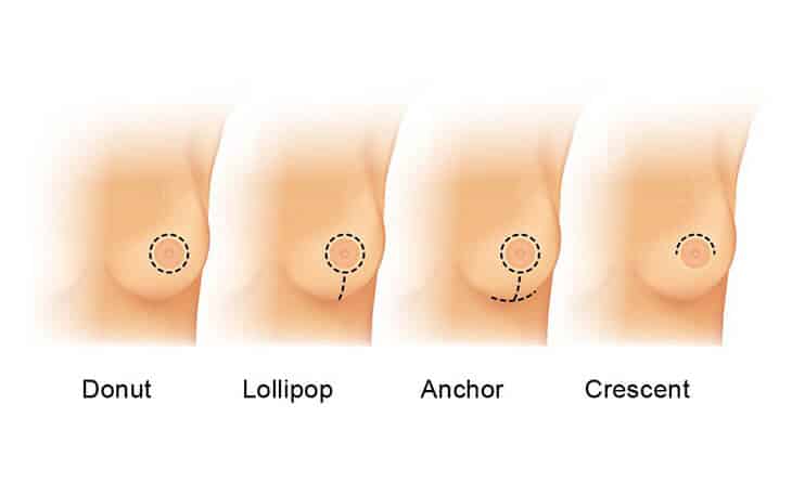 Breast Implant Cost in Delhi