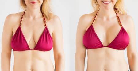 breast implants in delhi