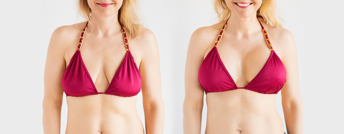 breast implants in delhi