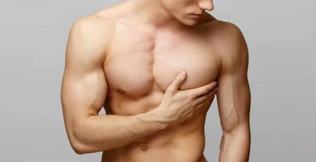 Gynecomastia