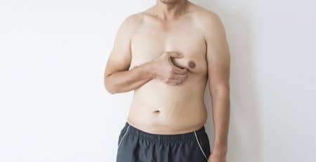 Gynecomastia