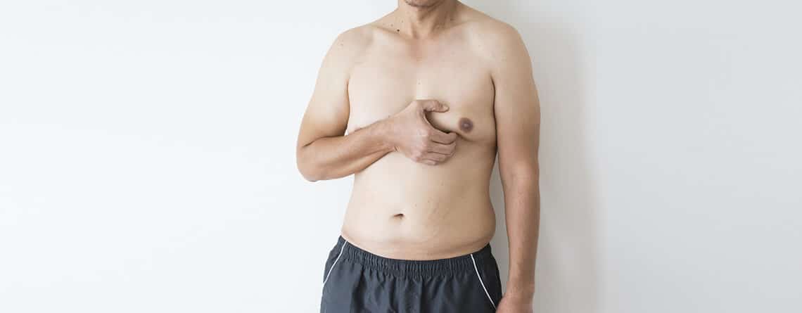 Gynecomastia