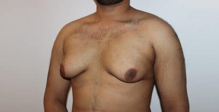Gynecomastia