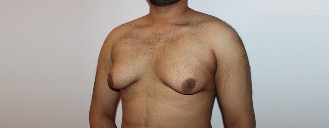 Gynecomastia