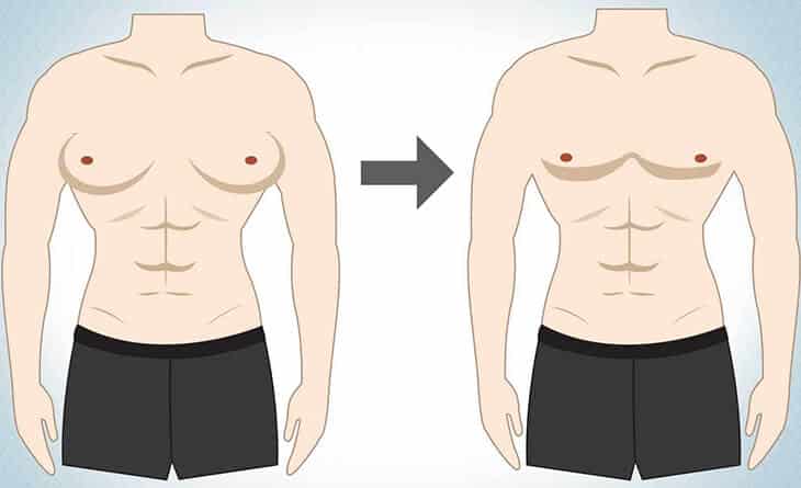 Gynecomastia Surgery