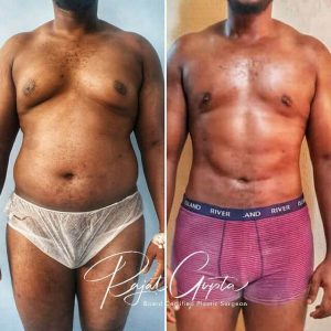 Liposuction surgery