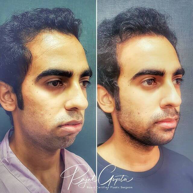chin augmentation