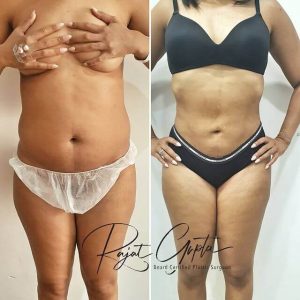 Liposuction surgery