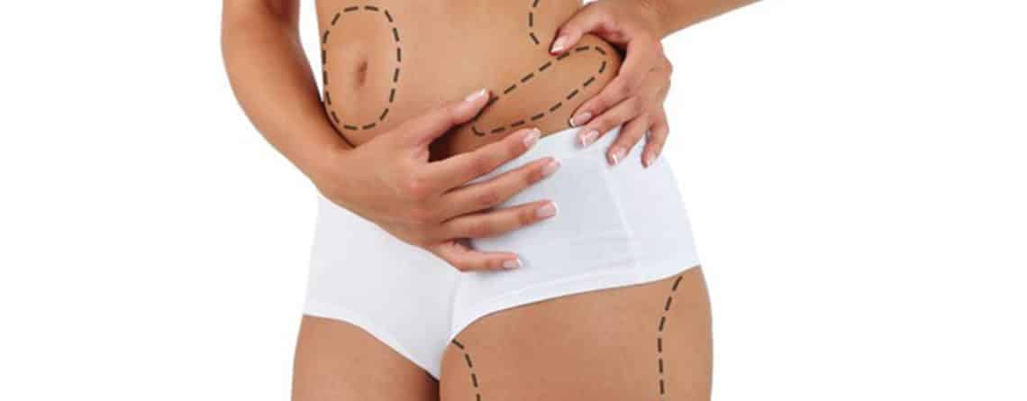 Liposuction Procedure