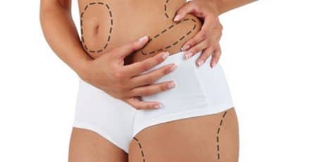 Liposuction Procedure