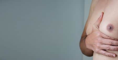 gynecomastia surgery in delhi