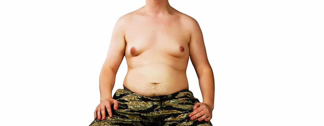 gynecomastia surgery in delhi