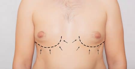 gynecomastia surgery in delhi