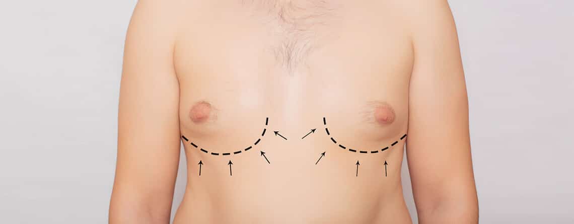 gynecomastia surgery in delhi
