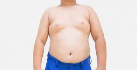 gynecomastia surgery in delhi