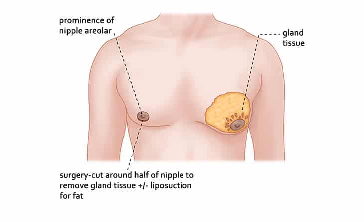 gynecomastia surgery in delhi