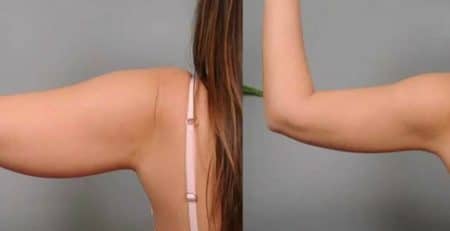 arm liposuction