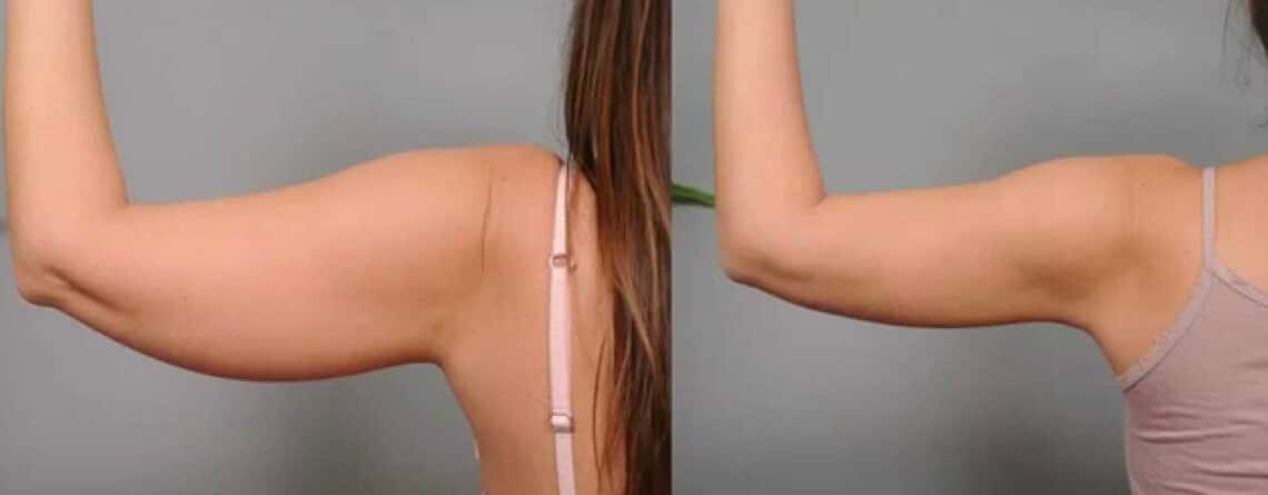 arm liposuction