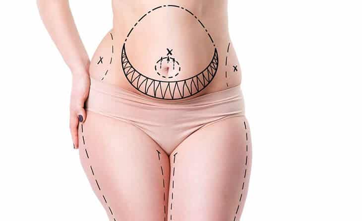 liposuction surgery in delhi