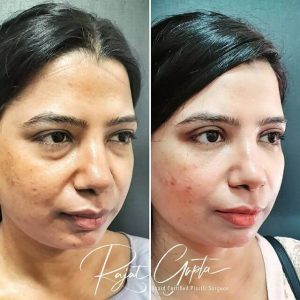 blepharoplasty