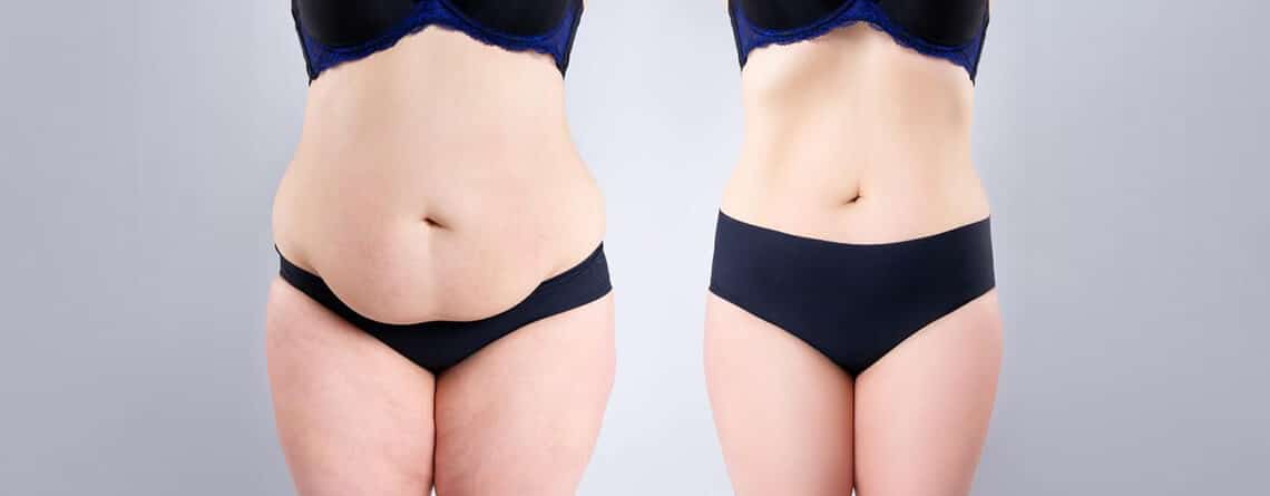 Tummy Tuck Surgery in Delhi