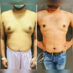 Gynecomastia
